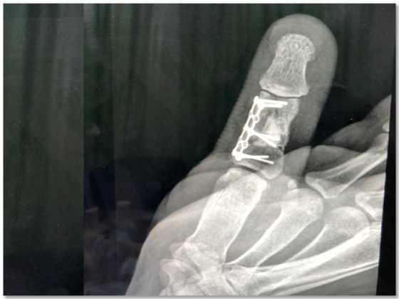 peripheral-nerve-surgery