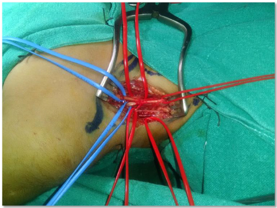peripheral-nerve-surgery